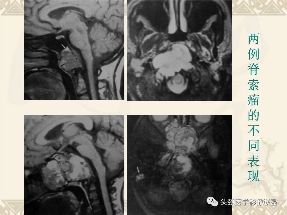 【PPT】颅骨肿瘤的影像学诊断与鉴别诊断-105