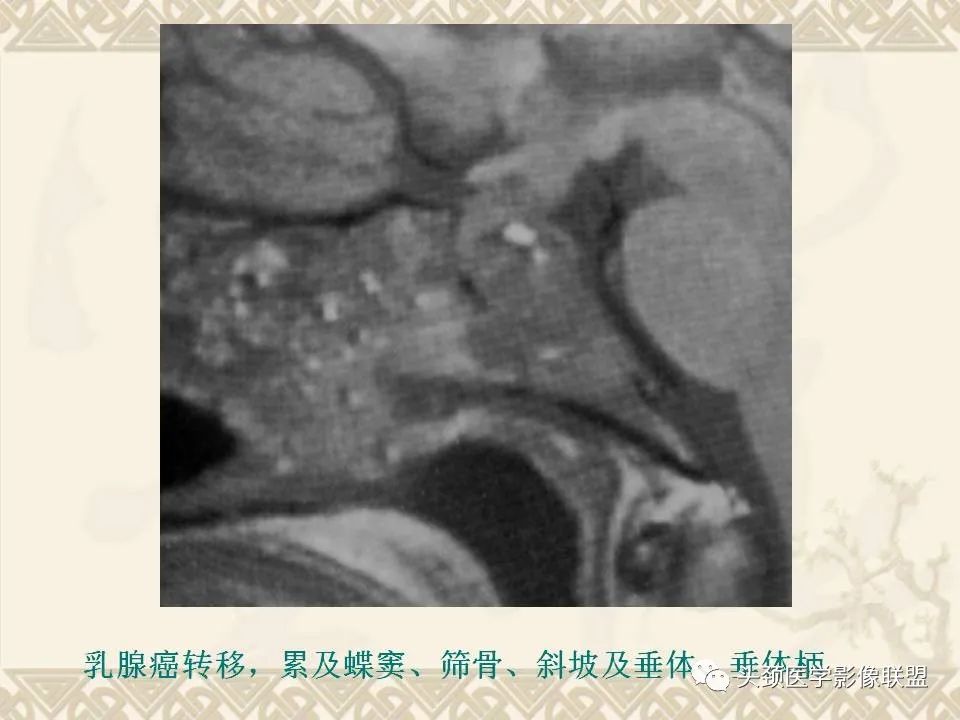 【PPT】颅骨肿瘤的影像学诊断与鉴别诊断-108