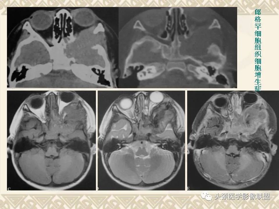 【PPT】颅骨肿瘤的影像学诊断与鉴别诊断-109
