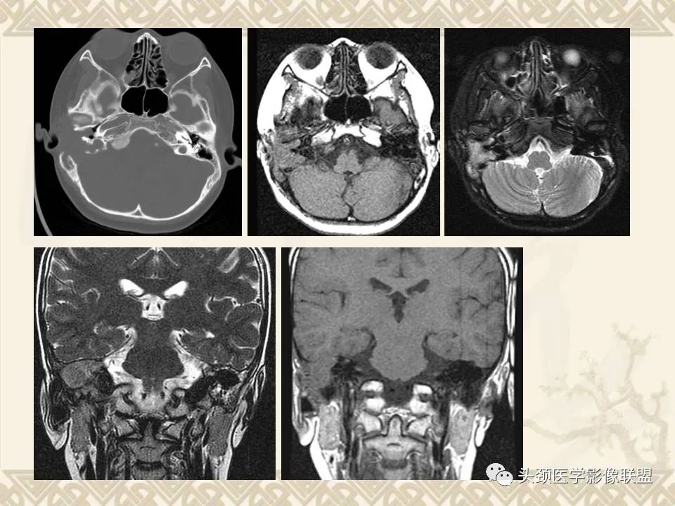 【PPT】颅骨肿瘤的影像学诊断与鉴别诊断-110