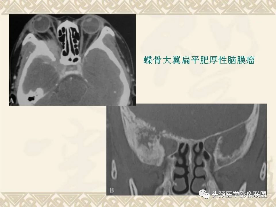 【PPT】颅骨肿瘤的影像学诊断与鉴别诊断-111