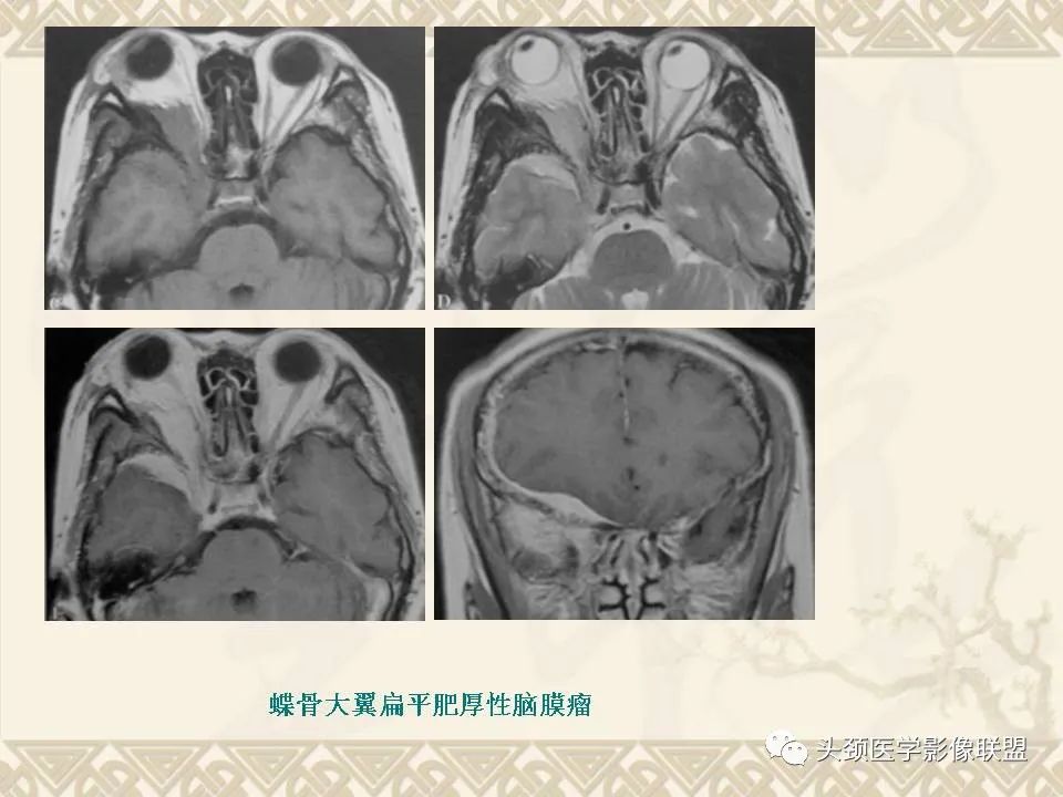 【PPT】颅骨肿瘤的影像学诊断与鉴别诊断-112