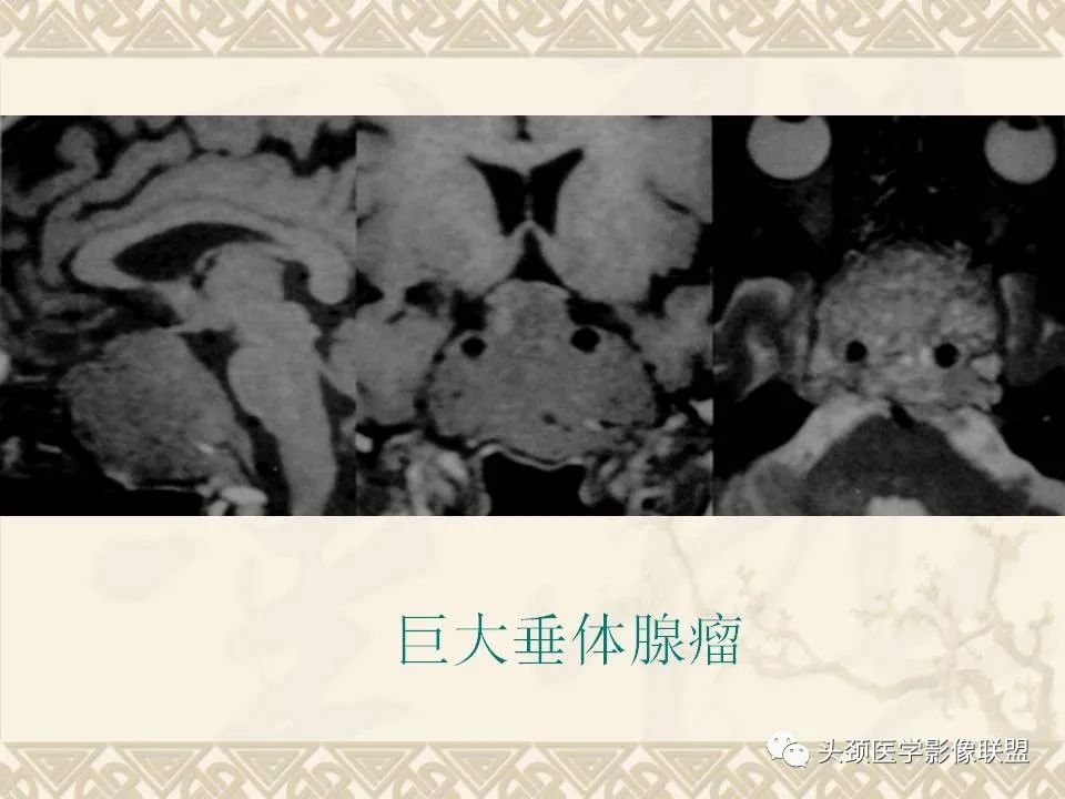 【PPT】颅骨肿瘤的影像学诊断与鉴别诊断-113