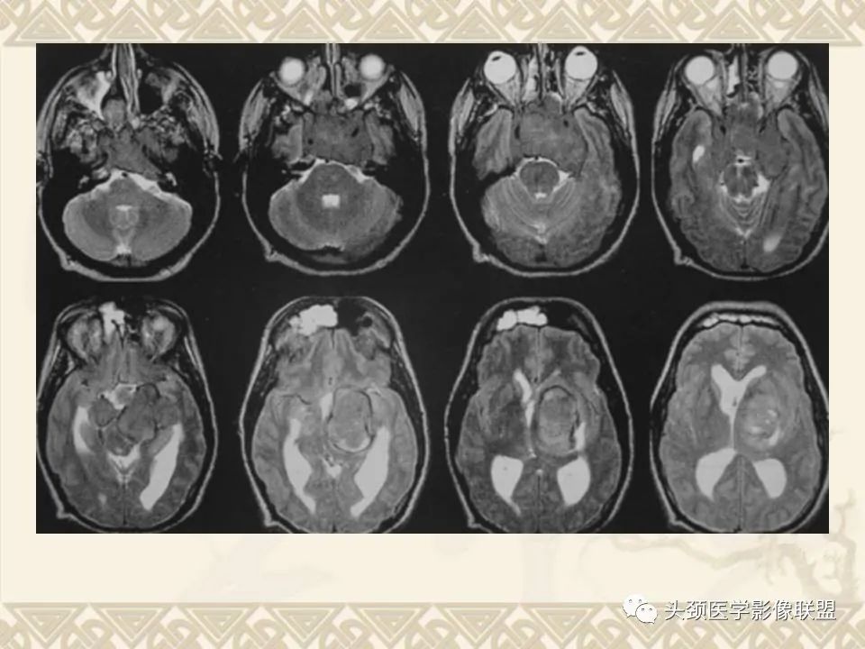 【PPT】颅骨肿瘤的影像学诊断与鉴别诊断-114