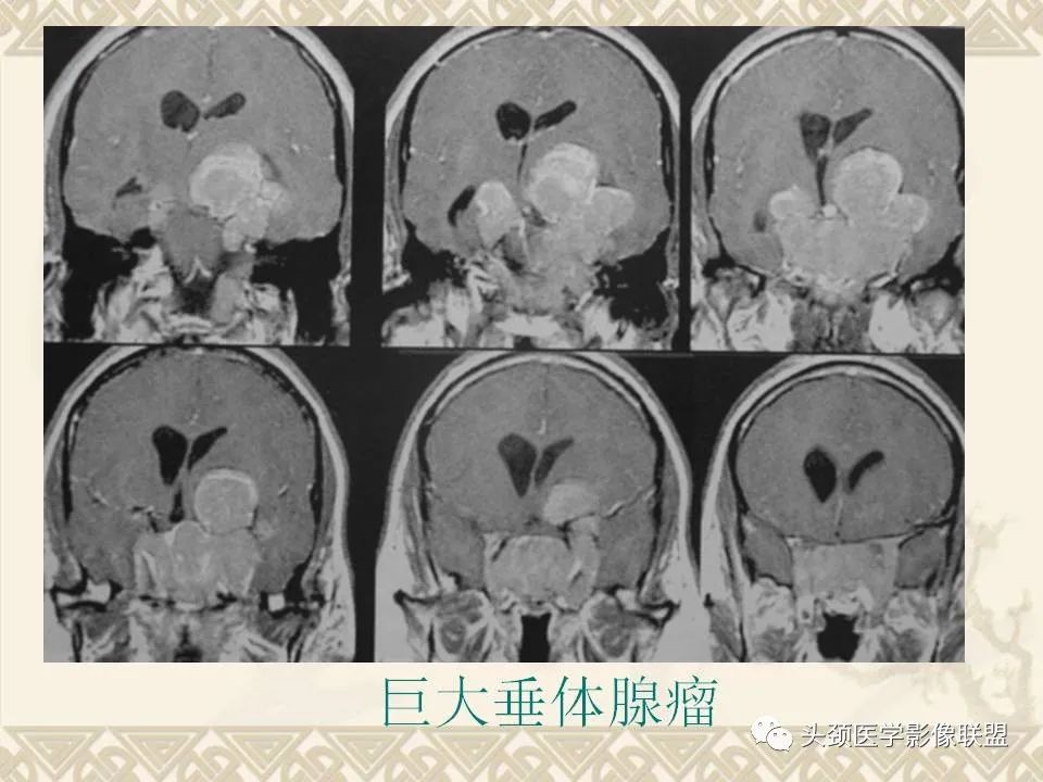 【PPT】颅骨肿瘤的影像学诊断与鉴别诊断-115