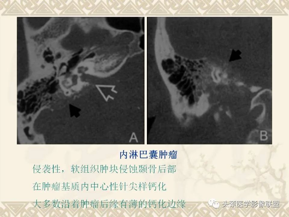 【PPT】颅骨肿瘤的影像学诊断与鉴别诊断-116