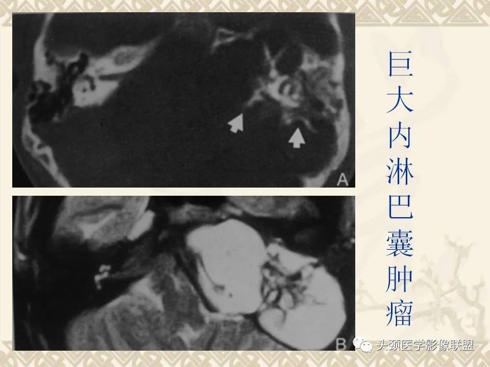 【PPT】颅骨肿瘤的影像学诊断与鉴别诊断-118