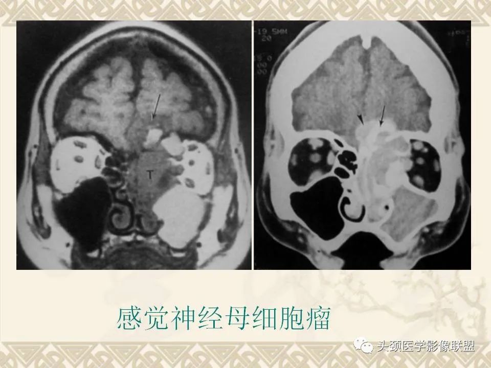 【PPT】颅骨肿瘤的影像学诊断与鉴别诊断-122