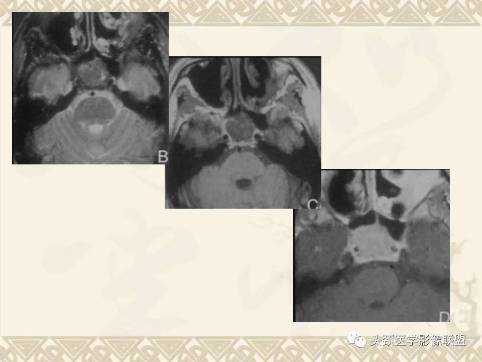 【PPT】颅骨肿瘤的影像学诊断与鉴别诊断-126