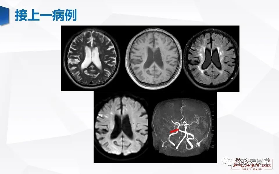 【PPT】DWI在脑卒中诊断中的作用-12