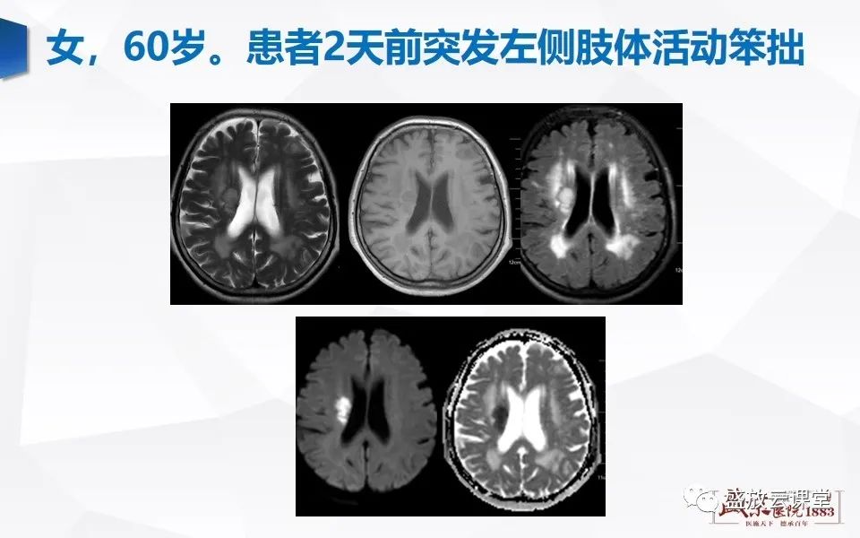 【PPT】DWI在脑卒中诊断中的作用-11