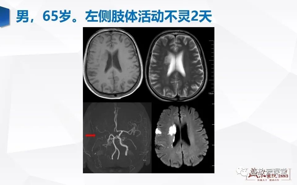 【PPT】DWI在脑卒中诊断中的作用-14