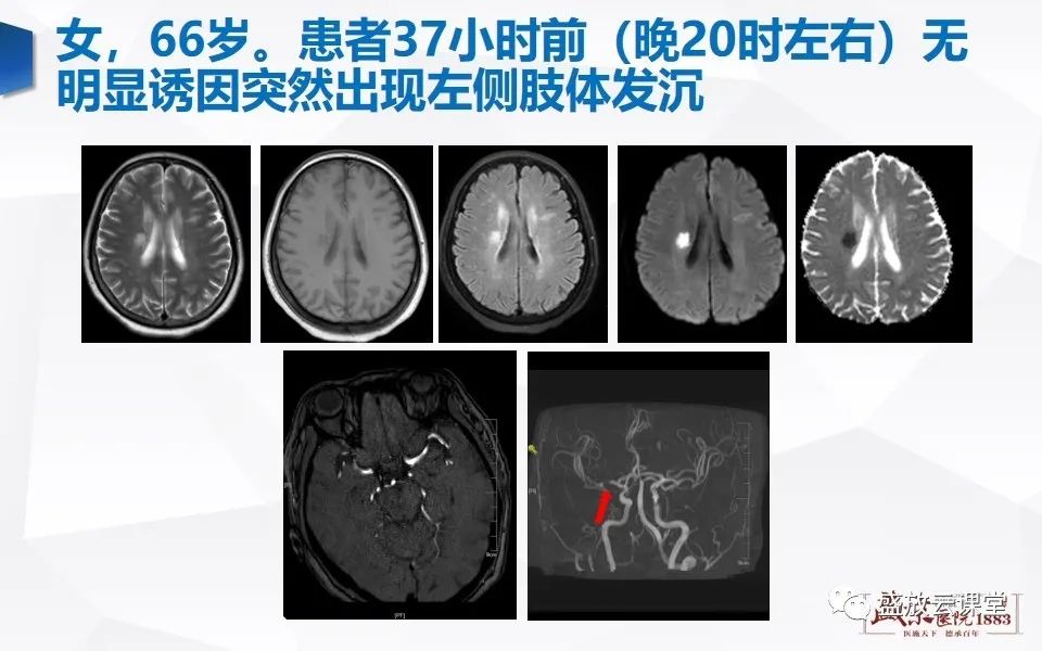 【PPT】DWI在脑卒中诊断中的作用-13