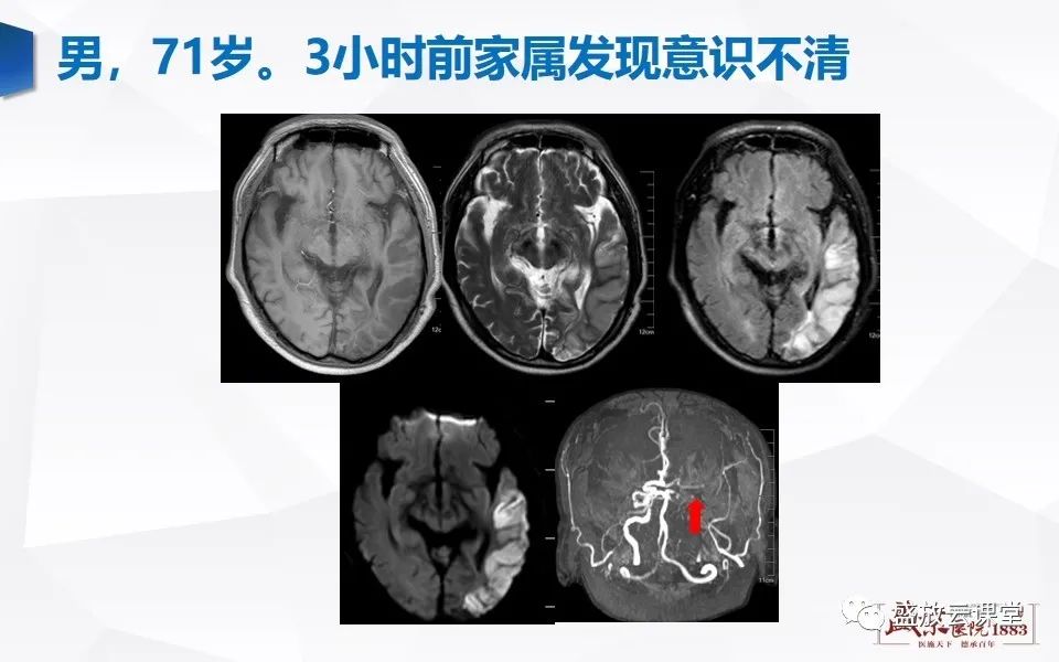【PPT】DWI在脑卒中诊断中的作用-16