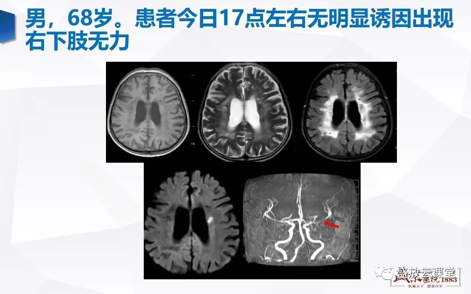 【PPT】DWI在脑卒中诊断中的作用-15
