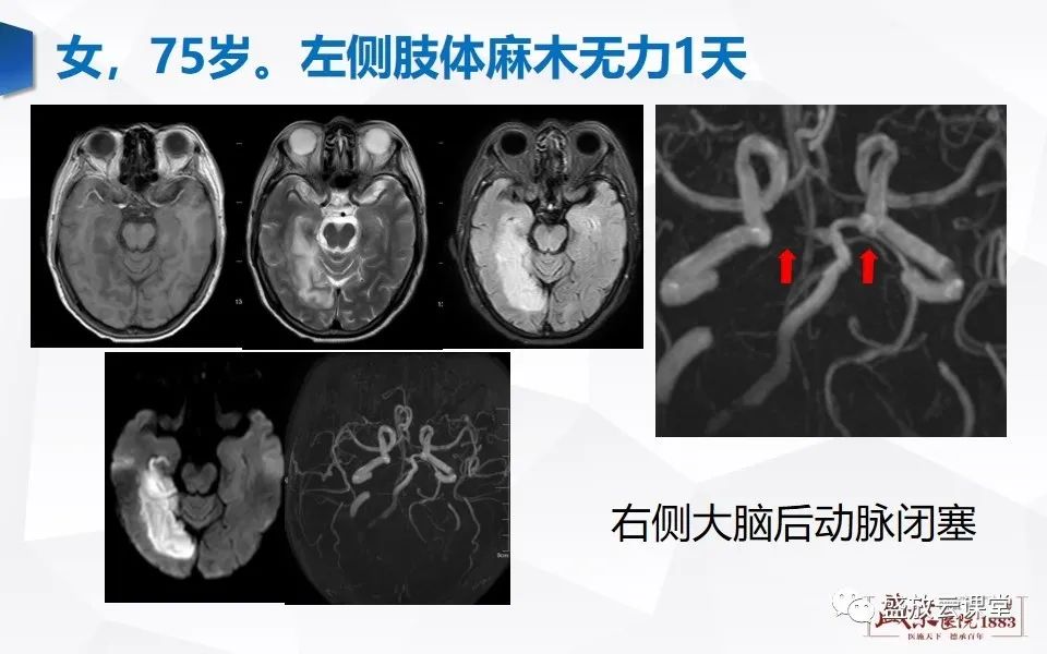 【PPT】DWI在脑卒中诊断中的作用-17