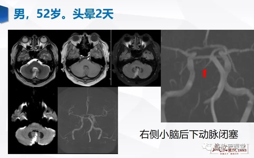 【PPT】DWI在脑卒中诊断中的作用-18