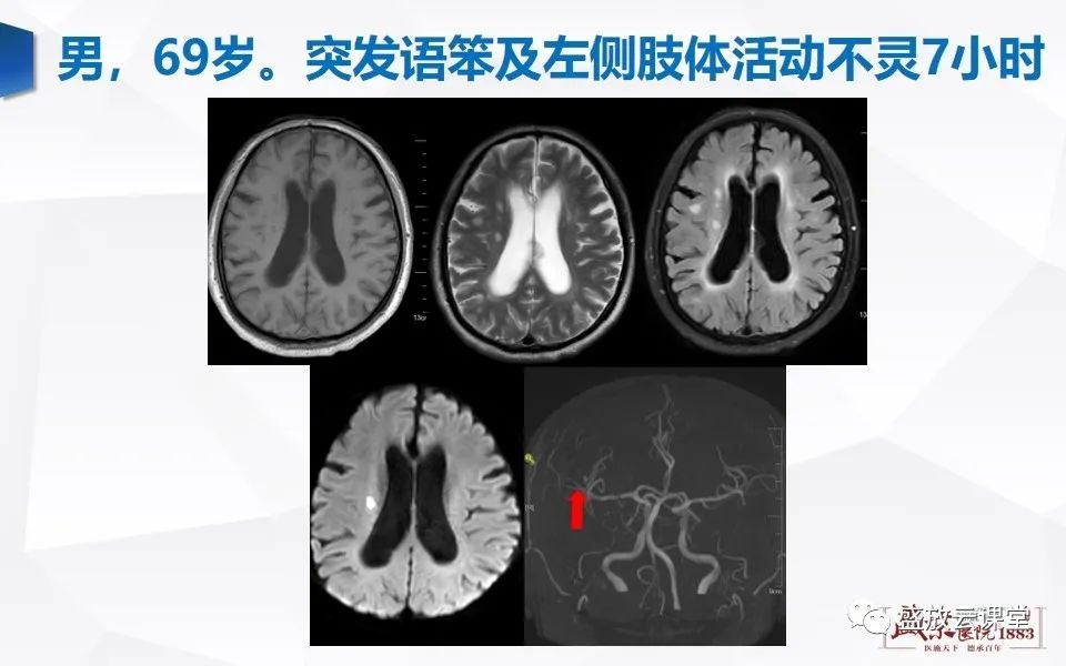 【PPT】DWI在脑卒中诊断中的作用-19