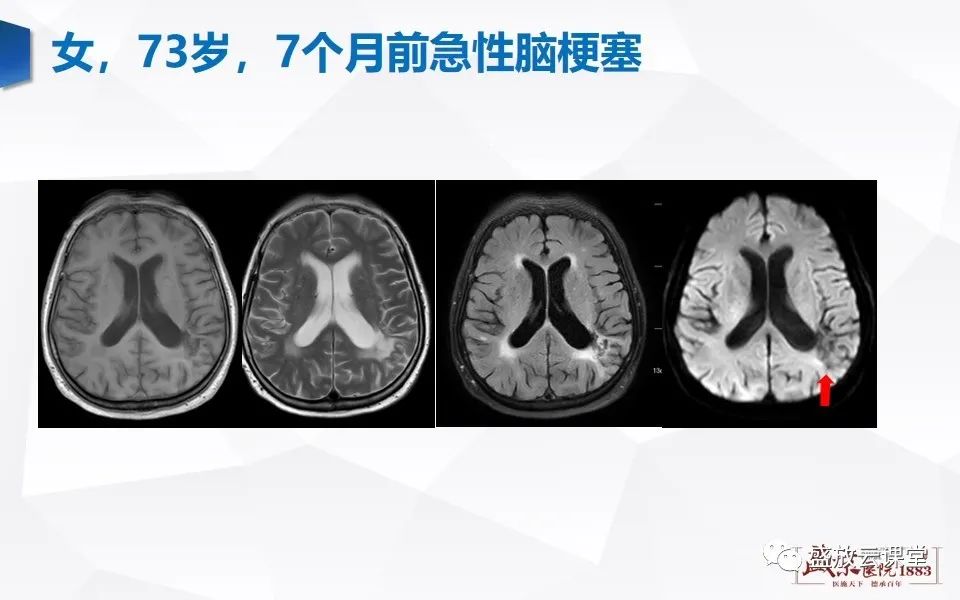 【PPT】DWI在脑卒中诊断中的作用-21