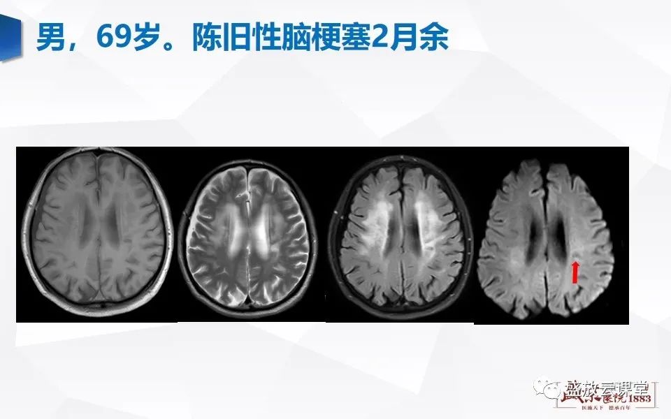 【PPT】DWI在脑卒中诊断中的作用-22