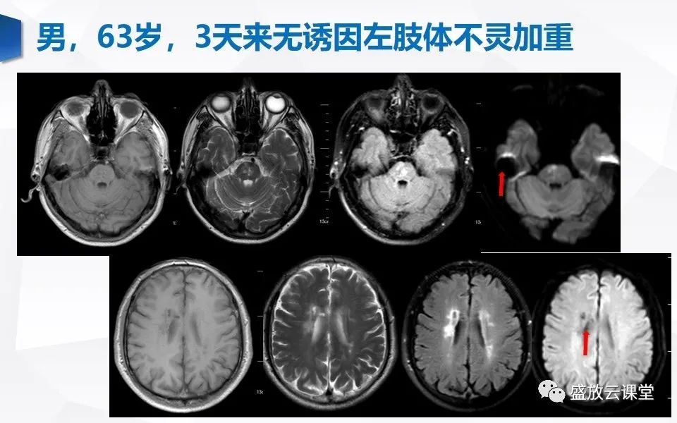 【PPT】DWI在脑卒中诊断中的作用-23