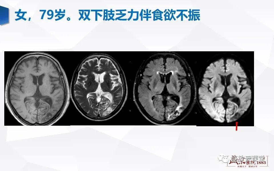 【PPT】DWI在脑卒中诊断中的作用-24