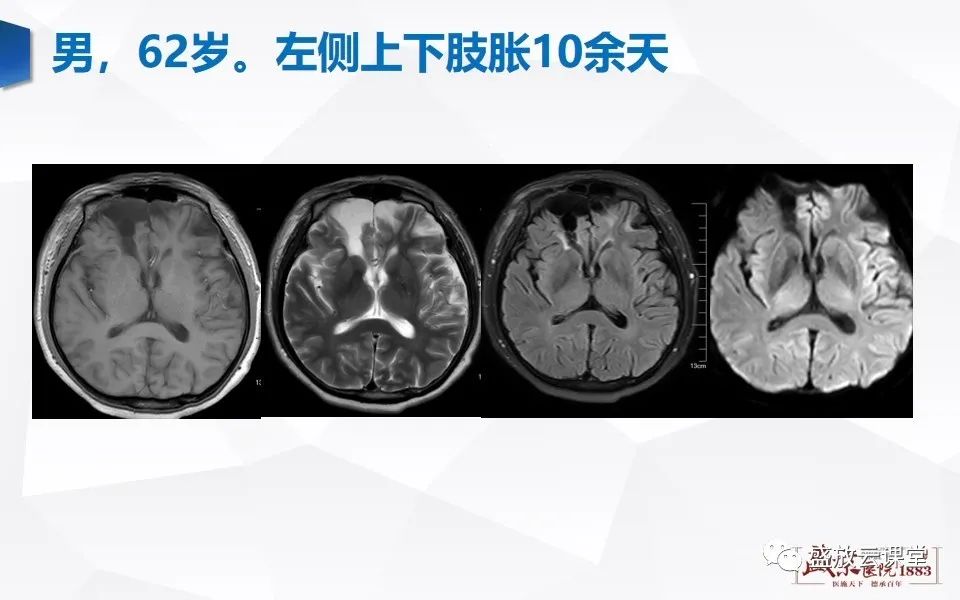 【PPT】DWI在脑卒中诊断中的作用-25