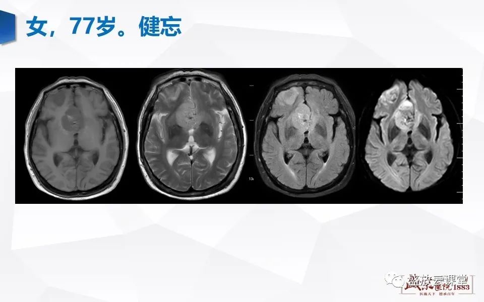 【PPT】DWI在脑卒中诊断中的作用-27