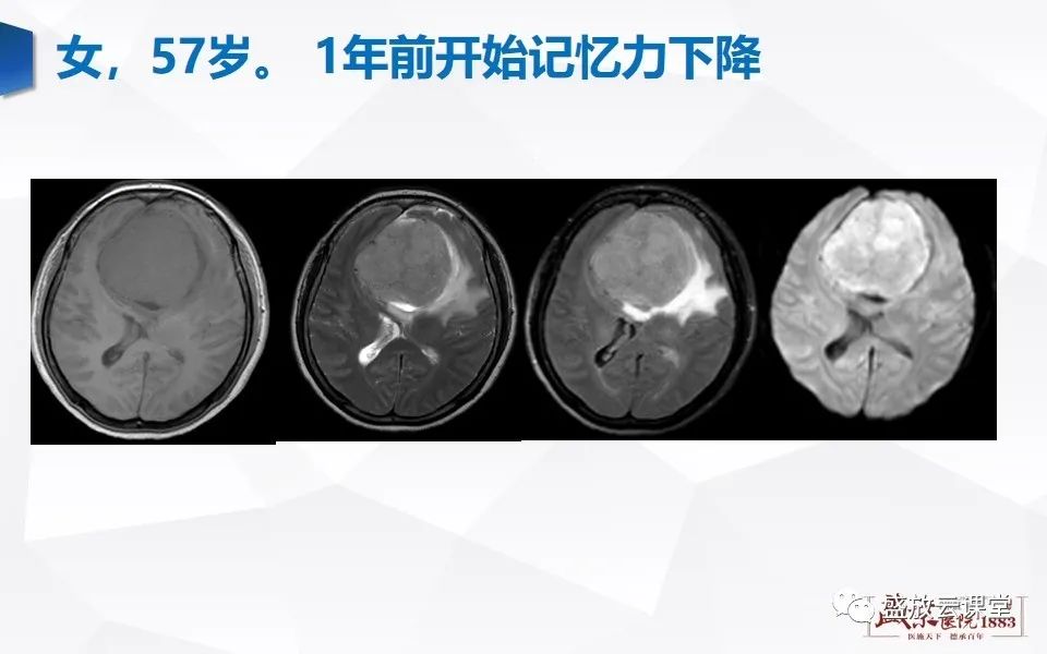 【PPT】DWI在脑卒中诊断中的作用-28