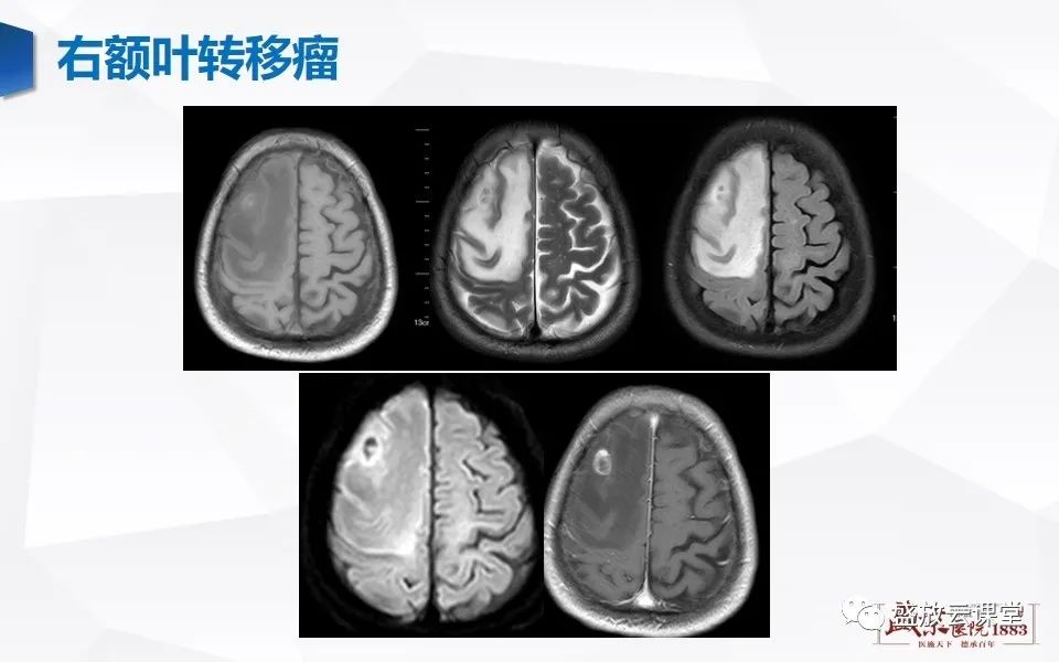 【PPT】DWI在脑卒中诊断中的作用-29