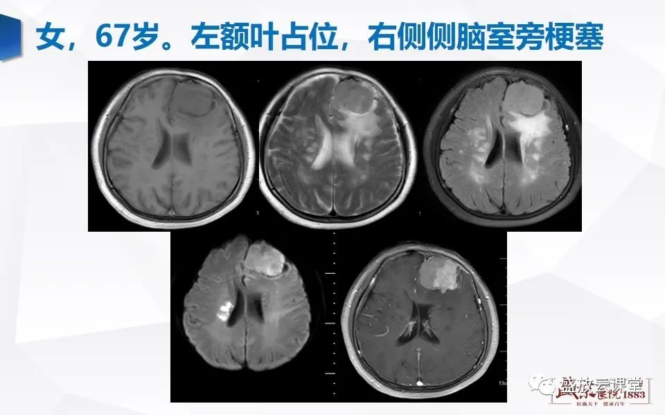 【PPT】DWI在脑卒中诊断中的作用-30