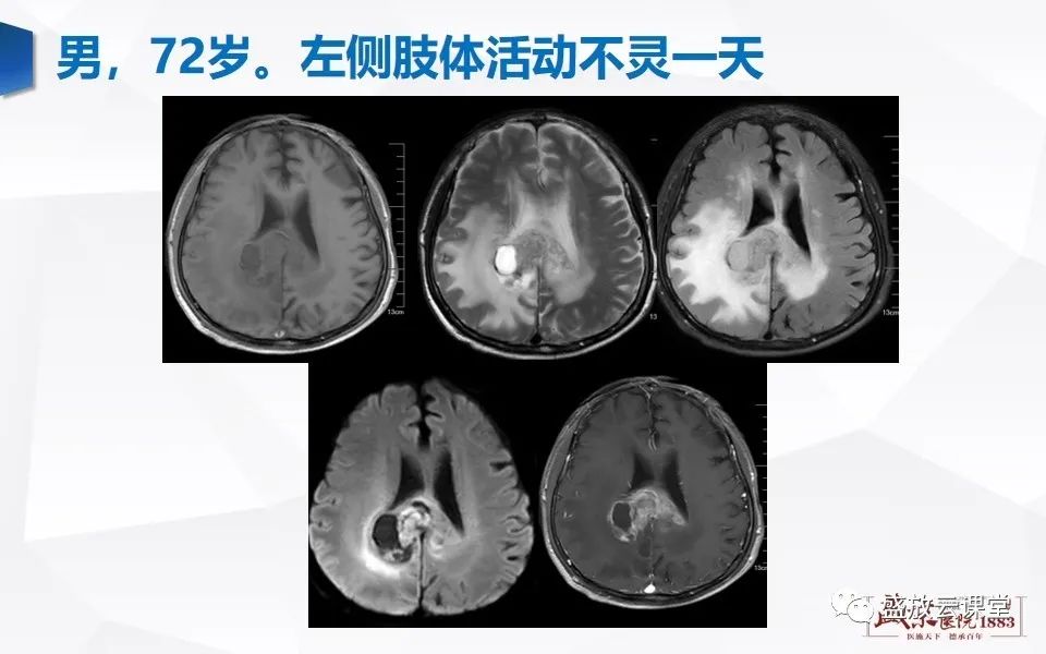 【PPT】DWI在脑卒中诊断中的作用-31
