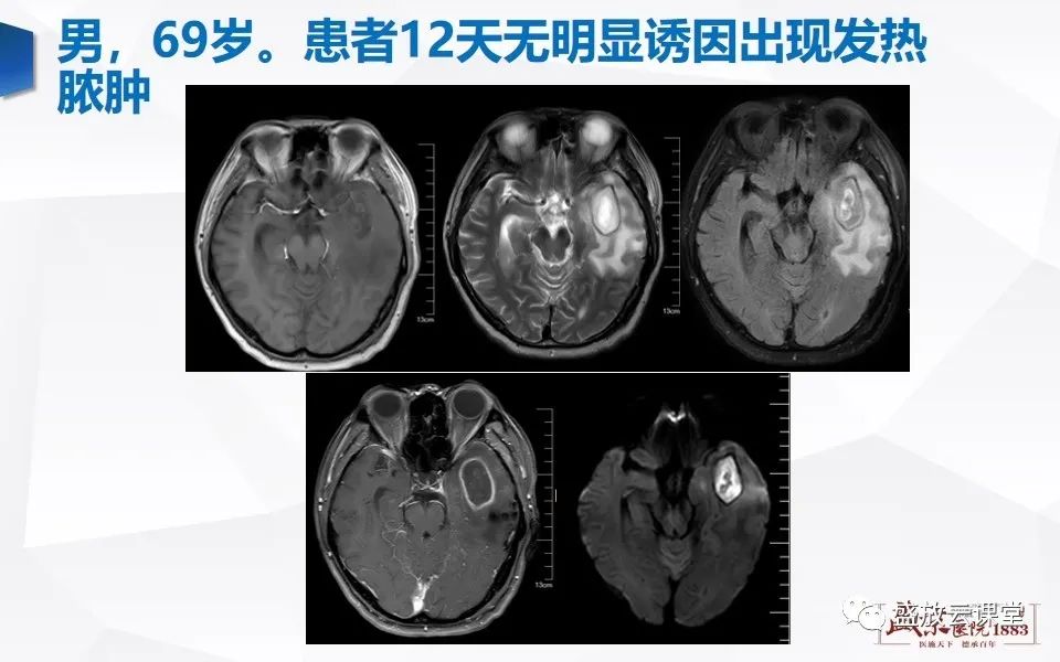 【PPT】DWI在脑卒中诊断中的作用-33