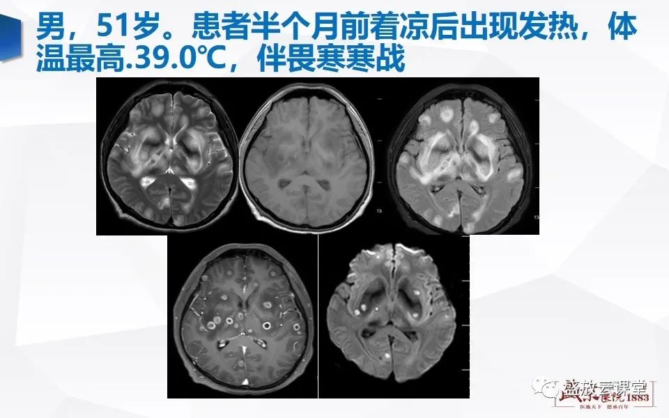 【PPT】DWI在脑卒中诊断中的作用-35