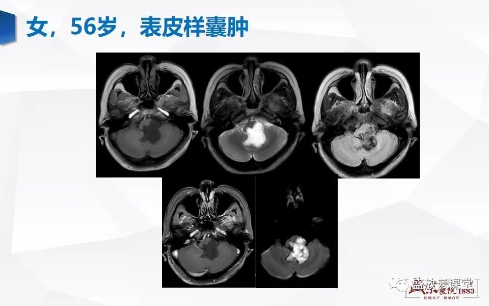 【PPT】DWI在脑卒中诊断中的作用-36