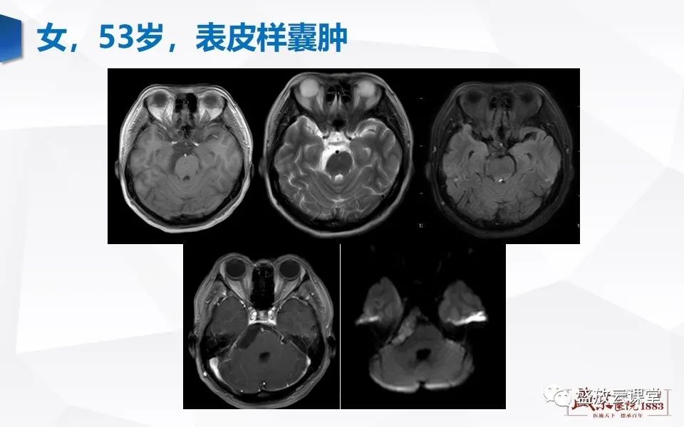 【PPT】DWI在脑卒中诊断中的作用-37