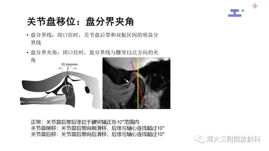 【PPT】颞下颌关节紊乱的影像学表现-16