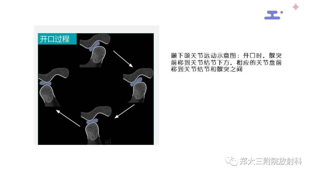 【PPT】颞下颌关节紊乱的影像学表现-17