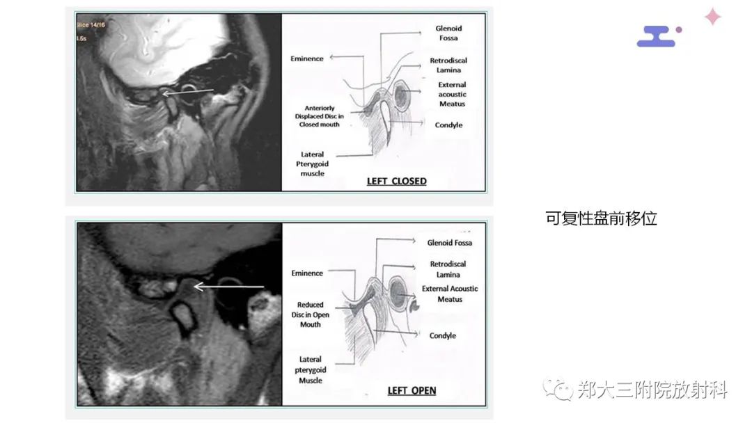 【PPT】颞下颌关节紊乱的影像学表现-23