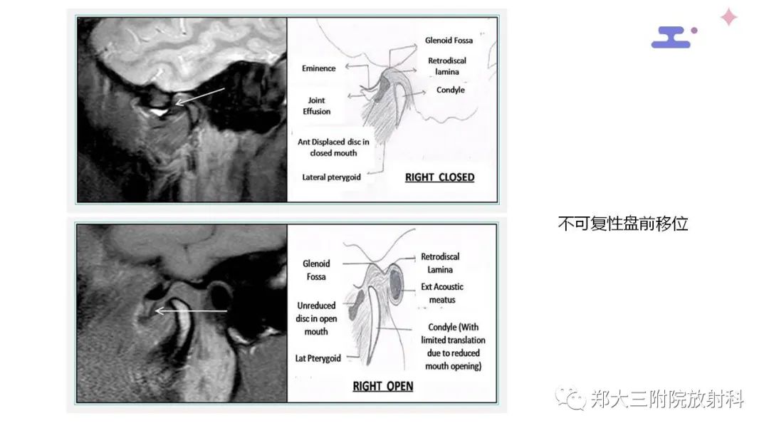 【PPT】颞下颌关节紊乱的影像学表现-24