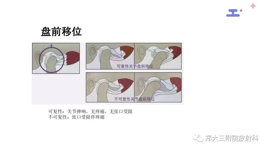 【PPT】颞下颌关节紊乱的影像学表现-22