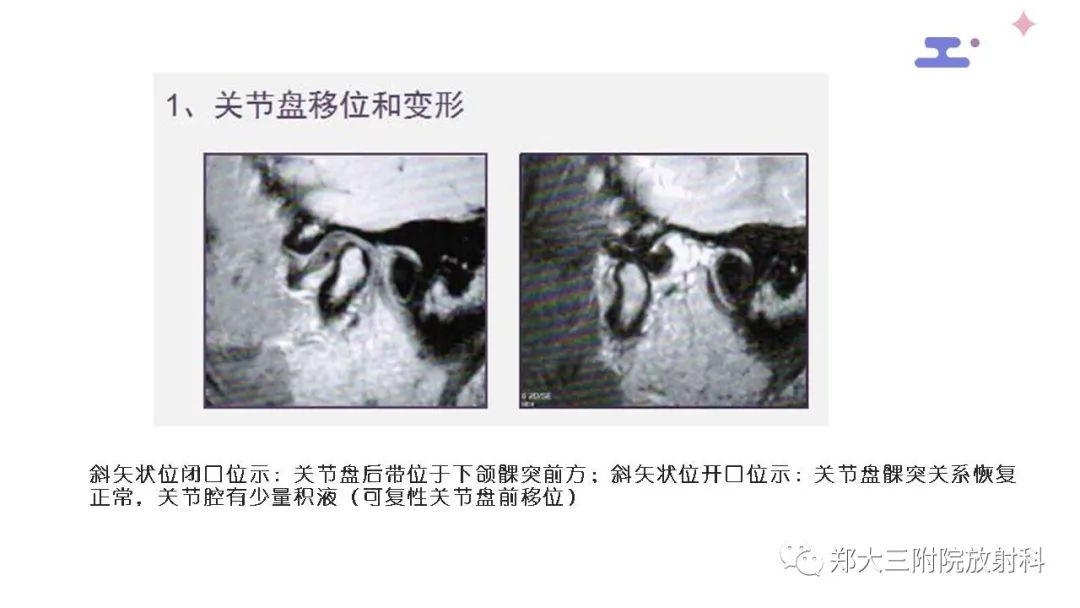 【PPT】颞下颌关节紊乱的影像学表现-25