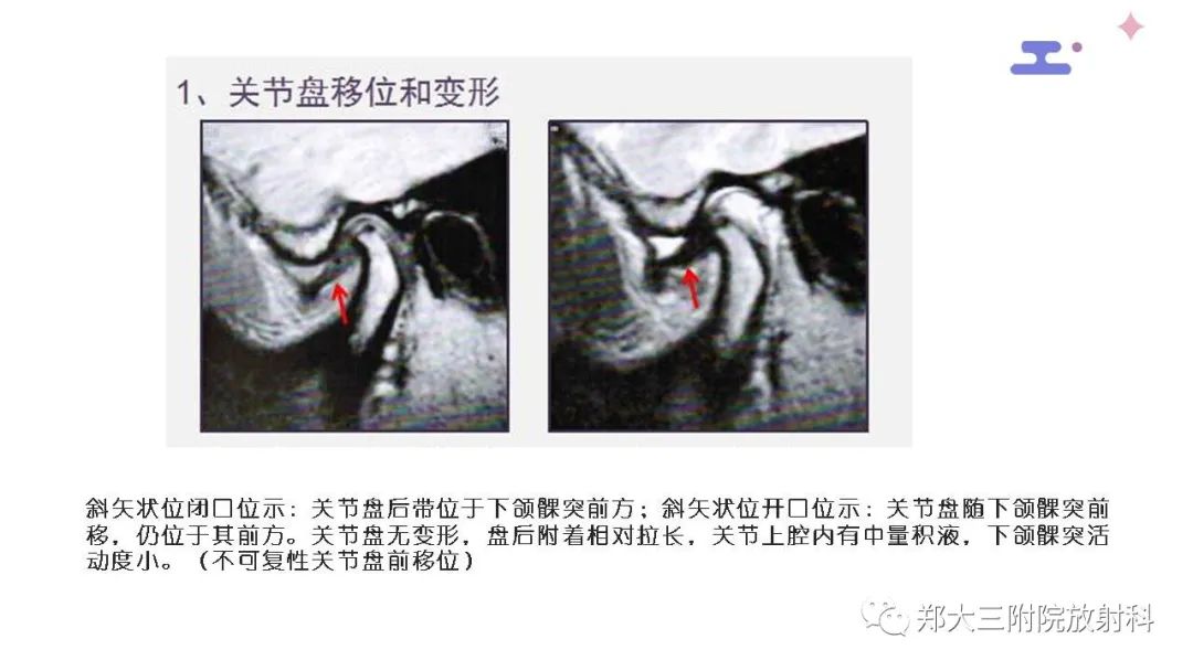 【PPT】颞下颌关节紊乱的影像学表现-26