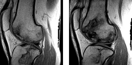 骨梗死影像学表现-2
