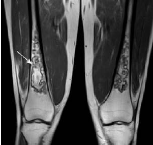 骨梗死影像学表现-1