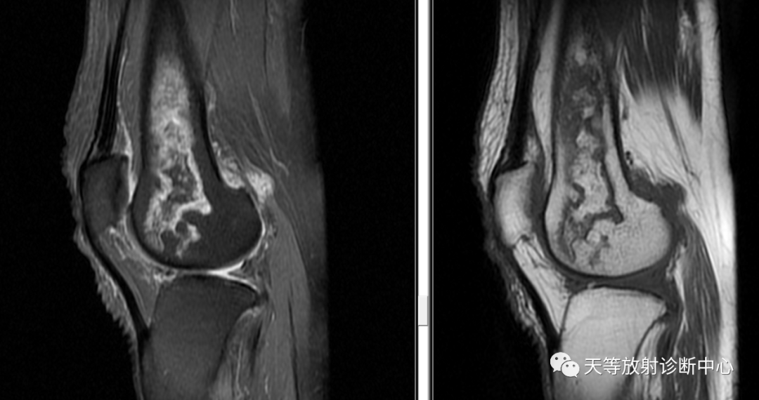 骨梗死影像学表现-4