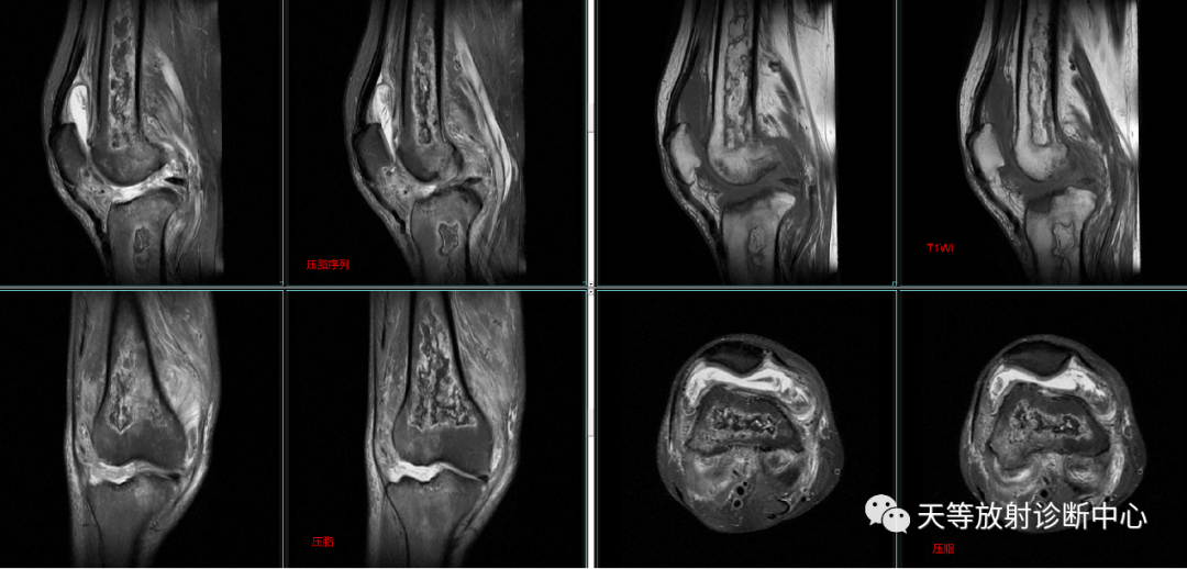 骨梗死影像学表现-3