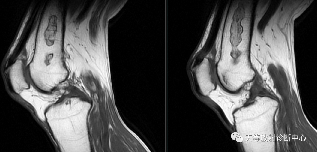 骨梗死影像学表现-5