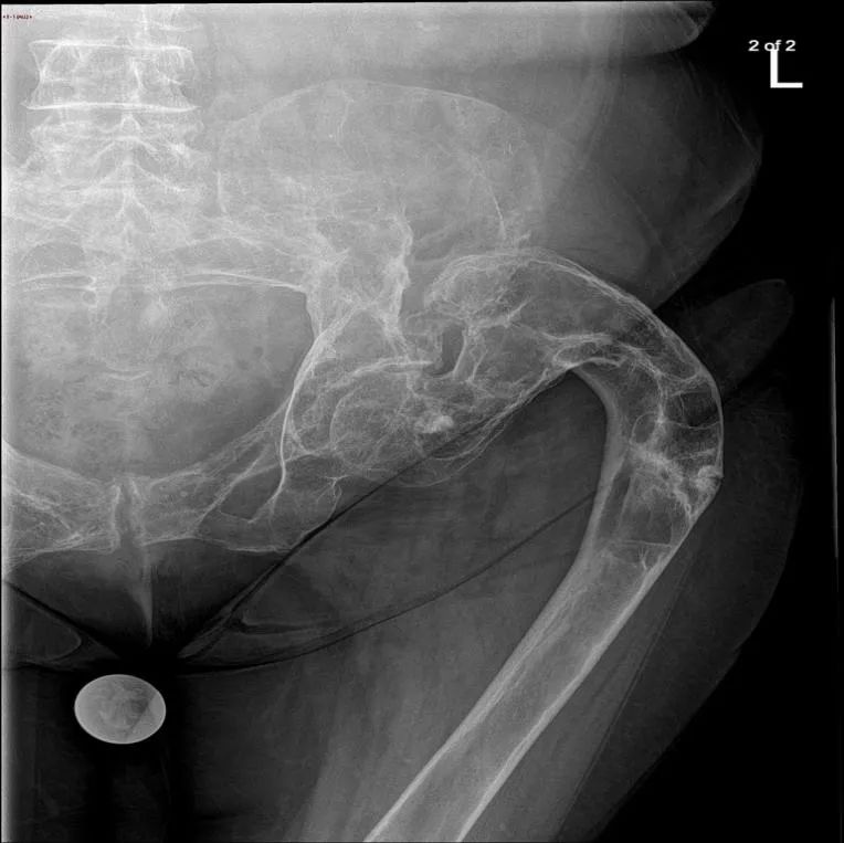 骨纤维异常增殖症是个什么病？影像表现原来是这样的……-2