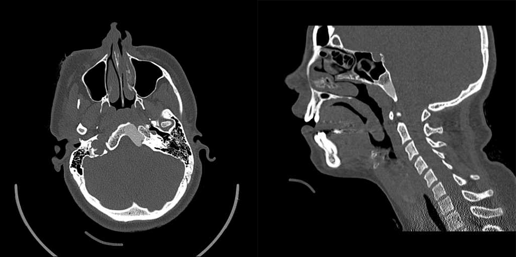 骨纤维异常增殖症是个什么病？影像表现原来是这样的……-3